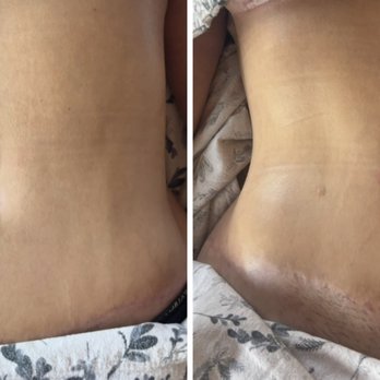 Healing Art of Massage By Paulette Kelly - Left before lymphatic massage
Right after lymphatic session - Massage Therapy Near Me Healing Art of Massage By Paulette Kelly - Left before lymphatic massage
Right after lymphatic session - Massage Therapy Near Me