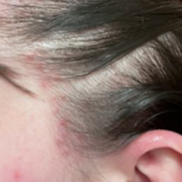 Allergic reaction/burn from neutral black hair dye Allergic reaction/burn from neutral black hair dye