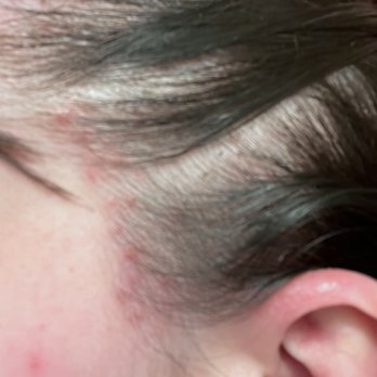 Trichology Salon - Allergic reaction/burn from neutral black hair dye - Hair Salons Near Me - Oklahoma City, Oklahoma Trichology Salon - Allergic reaction/burn from neutral black hair dye - Hair Salons Near Me - Oklahoma City, Oklahoma