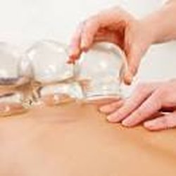 Therapeutic Massage - Blue Jay Physical Therapy - Massage cupping