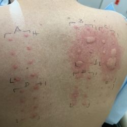 Nick Debnath,  MD FACS - Allergy test