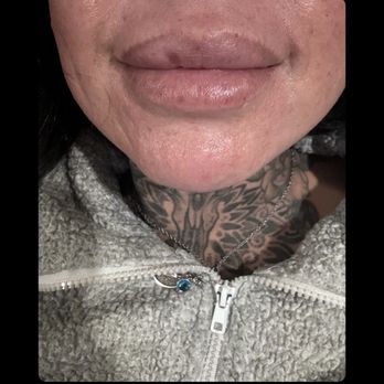 Glam Lab - Lip filler - Medical Spas Near Me - San Jacinto, California Glam Lab - Lip filler - Medical Spas Near Me - San Jacinto, California