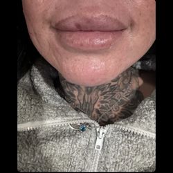 Glam Lab - Lip filler