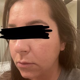 Morning after treatment Morning after treatment