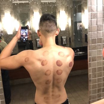 Performance Bodywork - Cup treatment by Anastasio - Massage Therapy Near Me - San Jose, California