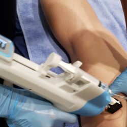 Microneedling RF. License Aesthetician