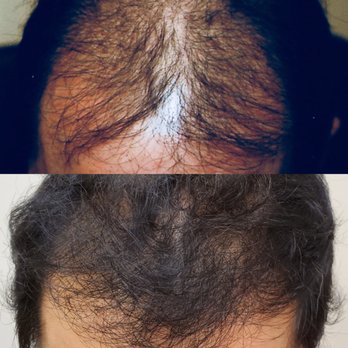 Tom Rosanelli, MD - PRP and Exosome treatment only. - Hair Loss Centers Near Me - Honolulu, Hawaii Tom Rosanelli, MD - PRP and Exosome treatment only. - Hair Loss Centers Near Me - Honolulu, Hawaii