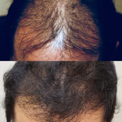 Tom Rosanelli, MD - PRP and Exosome treatment only.