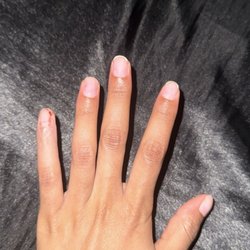 Nail injury