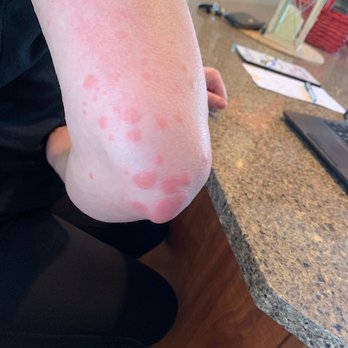 Eagle Ridge Resort - Bed bug bites on the back of my arm and elbow. I am covered in bites! It's disgusting! - Hotels Near Me - Galena, Illinois Eagle Ridge Resort - Bed bug bites on the back of my arm and elbow. I am covered in bites! It's disgusting! - Hotels Near Me - Galena, Illinois