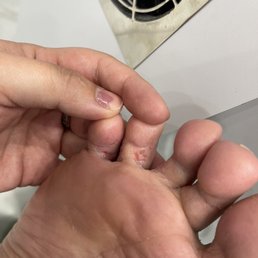 This is the chemical burn. Hurts to walk on and as the patch dries, it cracks open again and starts to bleed. This is the chemical burn. Hurts to walk on and as the patch dries, it cracks open again and starts to bleed.