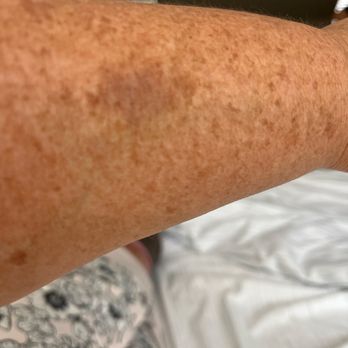 Olympus Spa - Brusing on left forearm from massage. - Day Spas Near Me - Lynnwood, Washington