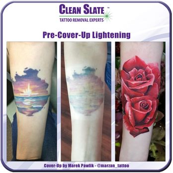 clean slate laser tattoo removal staten island