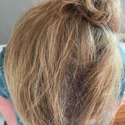 Midwest Follicle Center - You can't even see it, it blends so well, and NO MORE BALD SPOT!!