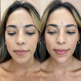 Plump Medspa - Jawline/chin filler - Medical Spas Near Me - Beaverton, Oregon