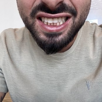 Craig I Hirasawa, DDS - After - Oral Surgeons Near Me - Sherman Oaks, California