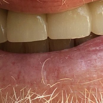 Dariusz P Kot, DDS, PC - Three tooth bridge!  Perfect smile! - General Dentistry Near Me - Fairfax, Virginia