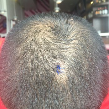 Advanced Dermatology - Stitches still in. Looks good - Dermatologists Near Me - Fresh Meadows, New York Advanced Dermatology - Stitches still in. Looks good - Dermatologists Near Me - Fresh Meadows, New York