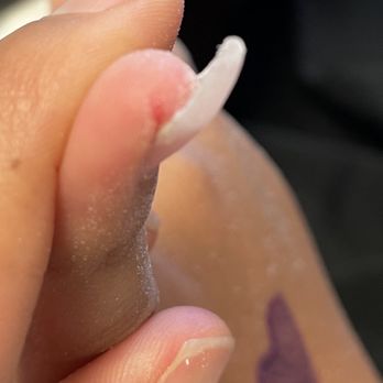 Lynn's Nail Bar - This is her pinky not as bad as her thumb but you can still see the wound. - Waxing Near Me - Monterey, California Lynn's Nail Bar - This is her pinky not as bad as her thumb but you can still see the wound. - Waxing Near Me - Monterey, California