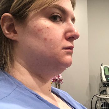 Orange County Liposuction Centers - The BEFORE in office the day of the procedure - Cosmetic Surgeons Near Me - Newport Beach, California