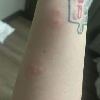 Great Wolf Lodge - Bed bug bites - Resorts Near Me - Scotrun, Pennsylvania