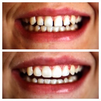 Meridian Dental - This is a Before and After of a patient that had small teeth with spaces that she wanted to fill. This was bonded resin. - Cosmetic Dentists Near Me - Falcon, Colorado Meridian Dental - This is a Before and After of a patient that had small teeth with spaces that she wanted to fill. This was bonded resin. - Cosmetic Dentists Near Me - Falcon, Colorado