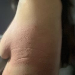 Allergic reaction from the oil they dont even know what the put on me
