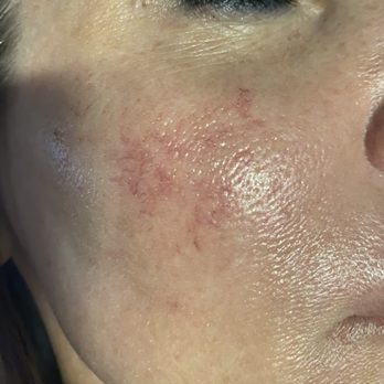 Fae Skin LV - Next morning - Skin Care Near Me - Las Vegas, Nevada