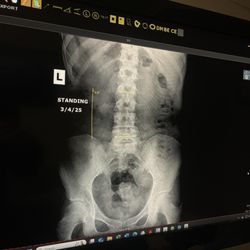 Stockton Family Chiropractic - This is the After! Standing up straight. I went with the 3-month treatment.