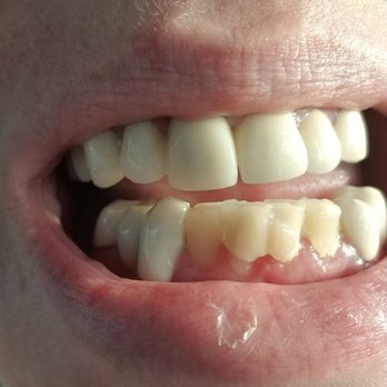 Comprehensive Family Dentistry - Terrible temporary crown placed on front bottom teeth. It was supposed to conver the front four bottom teeth, but didn't. Lumpy & crooked. - General Dentistry Near Me - Voorhees, New Jersey