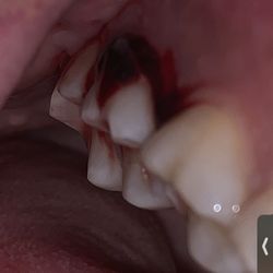 Prime Choice Dental - After just a cavity filling smh
