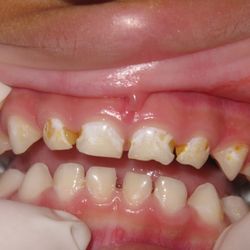 Suzanne Clift, DDS - Early childhood caries