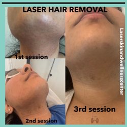 Laser Skin Wellness Center - laser hair removal just 3 sessions.
