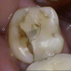 Sarnia Dental Care - Molar with large broken filling