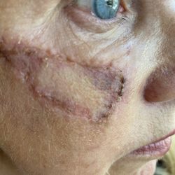 Simon Madorsky, MD - 3 months after surgery