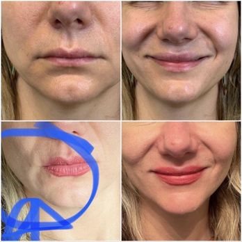 SK Aesthetics - Top row before bottom after - Aestheticians Near Me - State College, Pennsylvania SK Aesthetics - Top row before bottom after - Aestheticians Near Me - State College, Pennsylvania