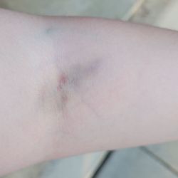 Greater Baden Medical Services - The bruising forming on my left arm.