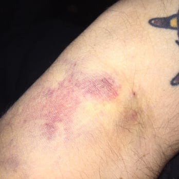 Octapharma Plasma - Colton - Bruise from the return - Blood & Plasma Donation Centers Near Me - Colton, California Octapharma Plasma - Colton - Bruise from the return - Blood & Plasma Donation Centers Near Me - Colton, California