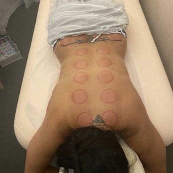 WTHN  - Cupping full Back - Acupuncture Near Me - New York, New York