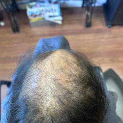 A Natural Image Hair Studio - Major frontal alopecia...