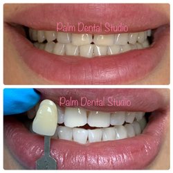 Palm Dental Studio - Amazing results with our professional in-office whitening treatment