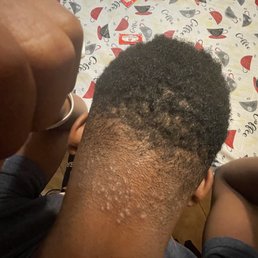 razor bumps razor bumps