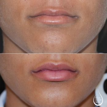 Blue Water Spa - Fuller Lips - Medical Spas Near Me - Raleigh, North Carolina