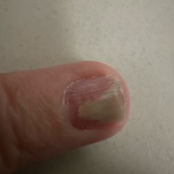 Peace Nails - This is currently the nail after months of treatment.
