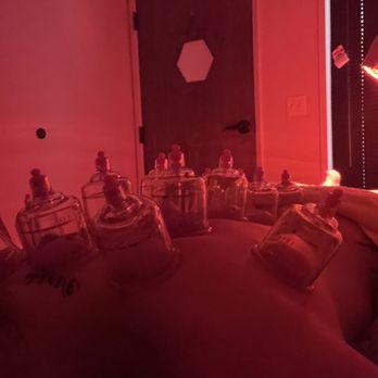 Kern Acupuncture - Cupping - Acupuncture Near Me - Bakersfield, California Kern Acupuncture - Cupping - Acupuncture Near Me - Bakersfield, California