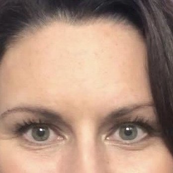AH Laser Aesthetics - Age 46 - Laser Hair Removal Near Me - Arlington Heights, Illinois