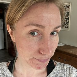 Black Light Beauty Bar - My skin 1 day after my first PCA peel