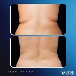 Trusclpt - Body Contouring - Back
