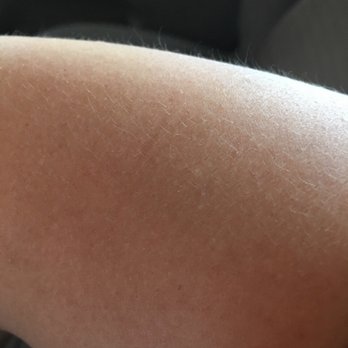 Quest Diagnostics - You can see the marks around my arm and it hurts!! She had the blue thing around my arm for minutes while she got ready. - Laboratory Testing Near Me - Covina, California Quest Diagnostics - You can see the marks around my arm and it hurts!! She had the blue thing around my arm for minutes while she got ready. - Laboratory Testing Near Me - Covina, California