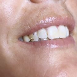 Styles Studio Hanalei - Tooth gems + whitening